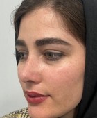 جراحی زیبایی - قبلاز عمل