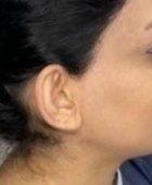 جراحی زیبایی گوش - بعداز عمل