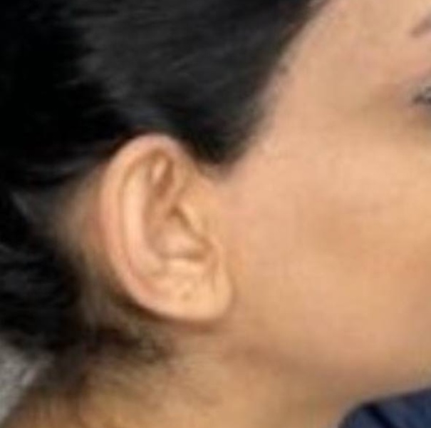 نمونه جراحی اتوپلاستی - قبلاز عمل