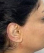 جراحی زیبایی گوش - قبلاز عمل