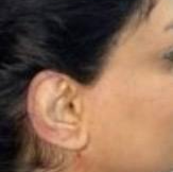 نمونه جراحی اتوپلاستی - بعداز عمل