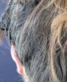 جراحی زیبایی گوش - قبلاز عمل