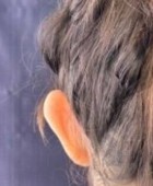 جراحی زیبایی گوش - بعداز عمل