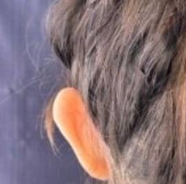 نمونه جراحی اتوپلاستی - قبلاز عمل