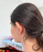 جراحی زیبایی گوش - بعداز عمل