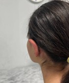 جراحی زیبایی گوش - قبلاز عمل