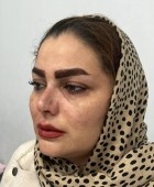 جراحی زیبایی بینی - قبلاز عمل