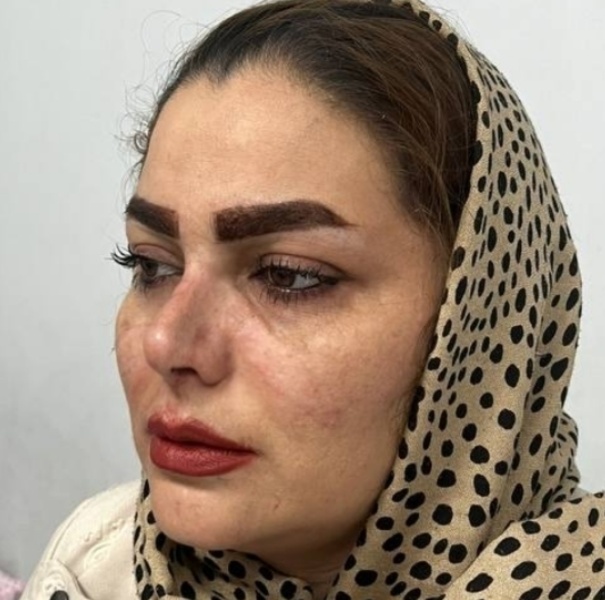نمونه جراحی رینوپلاستی - بعداز عمل