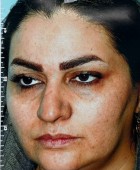 جراحی زیبایی بینی - بعداز عمل