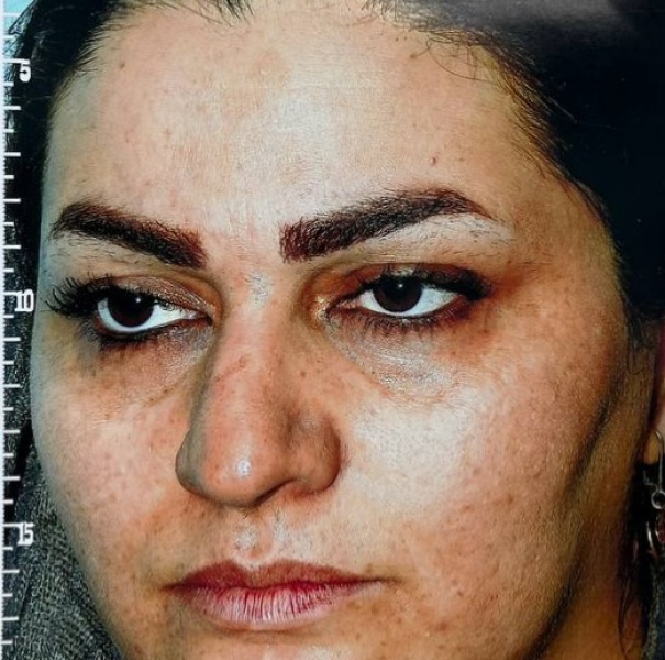 نمونه جراحی رینوپلاستی - قبلاز عمل