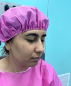 جراحی زیبایی بینی - بعداز عمل