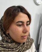 جراحی زیبایی بینی - قبلاز عمل